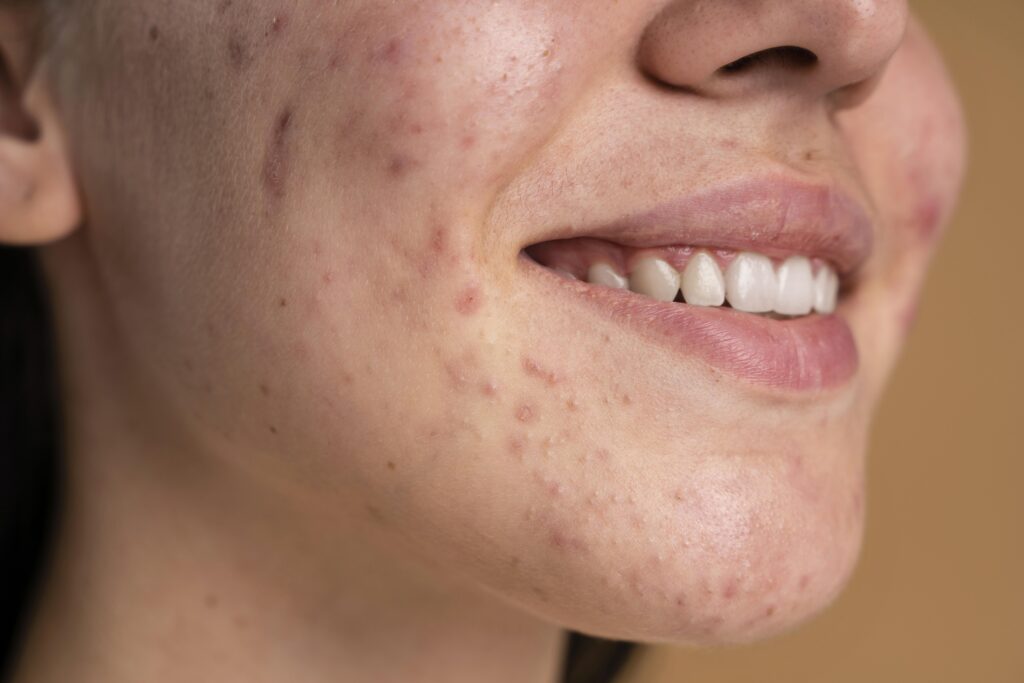 Treatment for Bump Acne