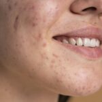 Treatment for Bump Acne